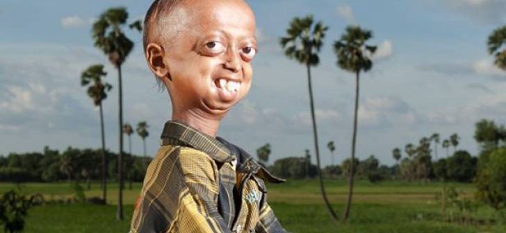 Progeria: Vezi GALERIA FOTO cu boala necruţătoare