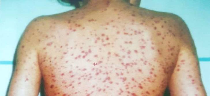 Copil in varsta de 7 ani cu o boala rara, internat la Spitalul Victor Babes din Timisoara. Medicii lupta pentru vindecarea lui – Opinia Timisoarei